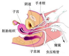 人流手术