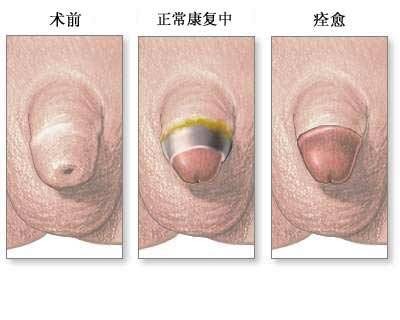 包皮