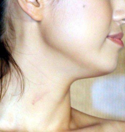 吻痕（因吸吮导致皮下出血的皮肤表现）