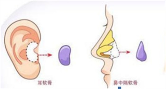 耳软骨隆鼻