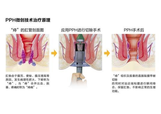 痔疮pph手术
