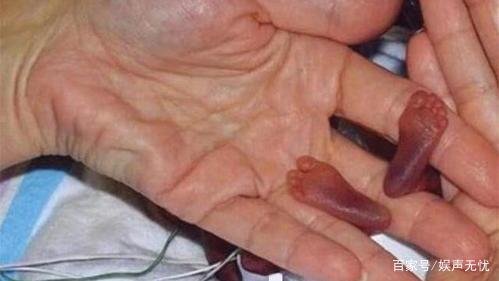 “比手掌还小”,世界最小婴儿走红,如今现状怎样了?