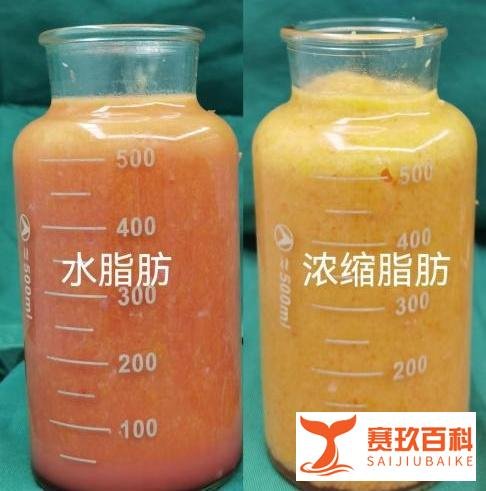选错脂肪丰胸3万块打水漂!不同脂肪效果差距有多明显?43岁求美者现身说法