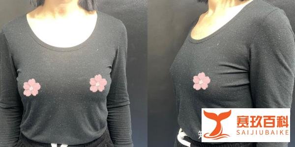 选错脂肪丰胸3万块打水漂!不同脂肪效果差距有多明显?43岁求美者现身说法