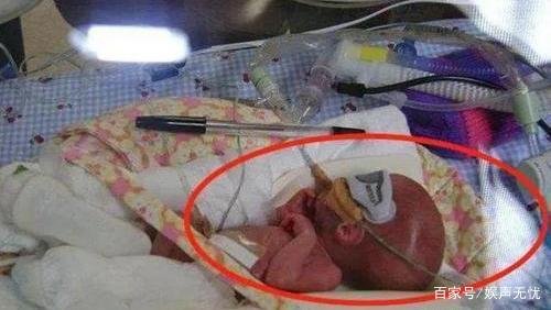 “比手掌还小”,世界最小婴儿走红,如今现状怎样了?