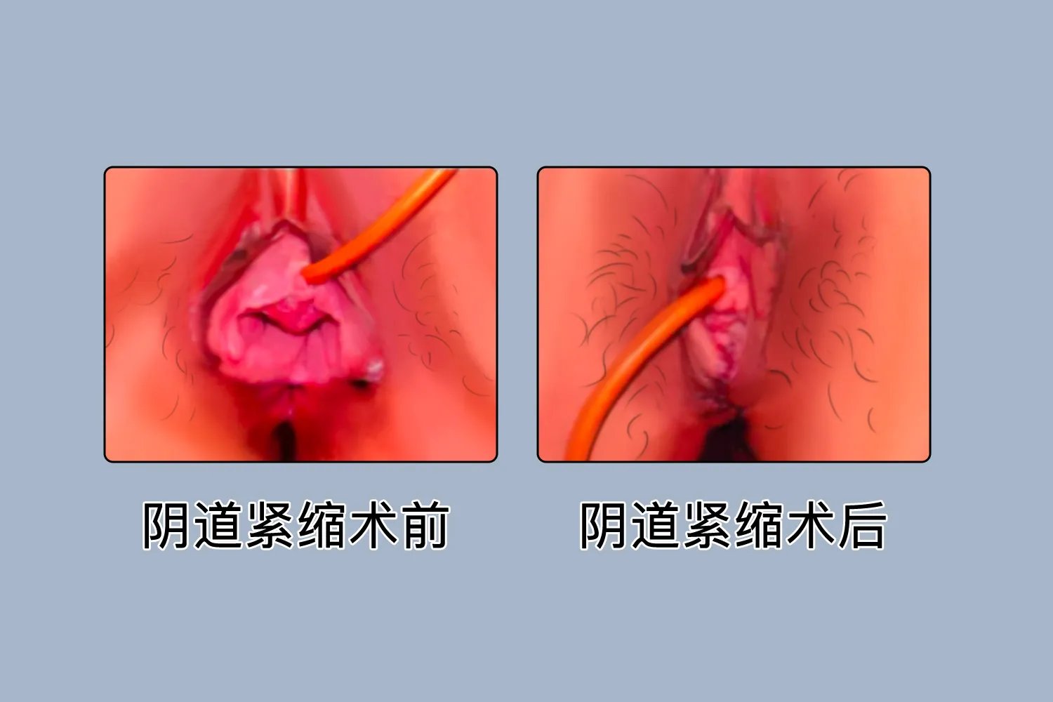 缩阴图片