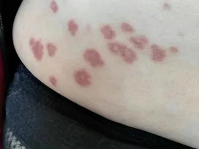 寻常型银屑病腰部红斑图片
