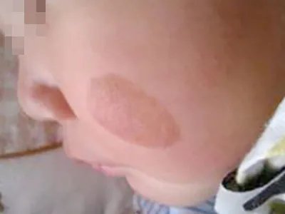 咖啡斑症状图片