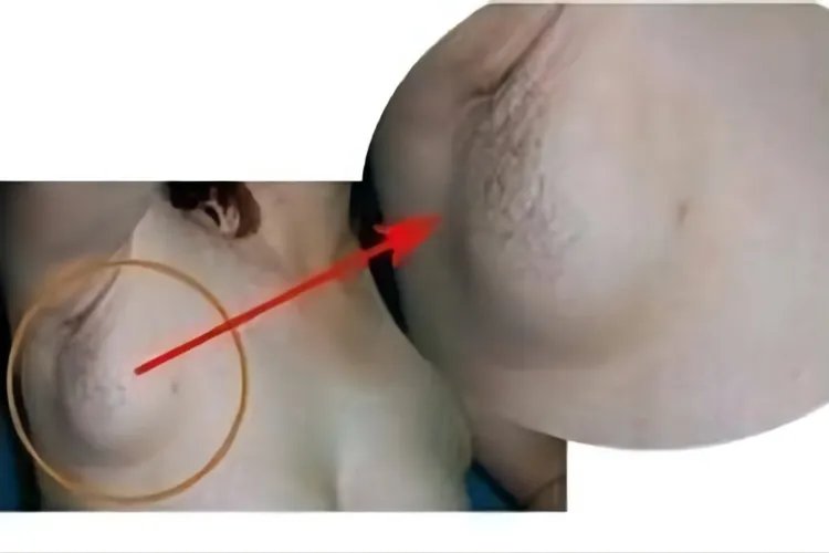 乳腺癌晚期真人图片