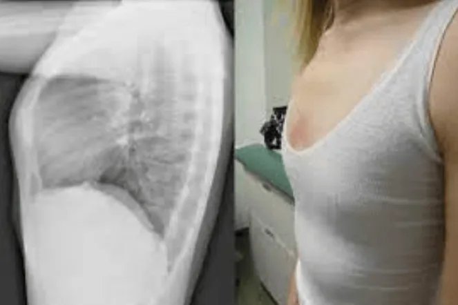 女生鸡胸图片胸骨凸起