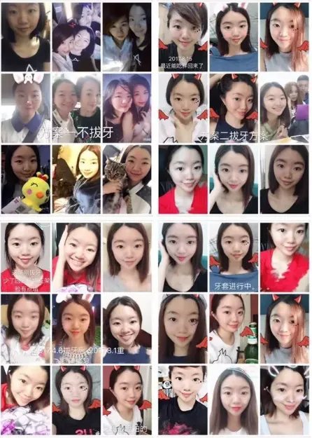 孙杨证明，牙齿正畸能让你变得更美！