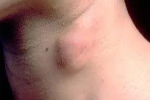 女性大脖子病前兆图片