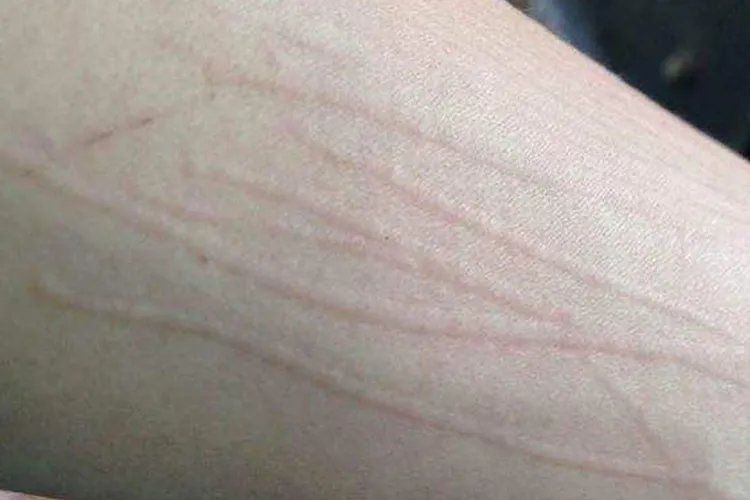 荨麻疹早期症状图片及治疗