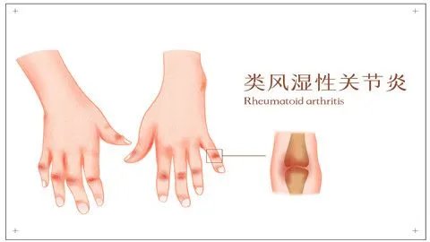 类风湿怎么办