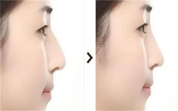 鼻翼缩小对比