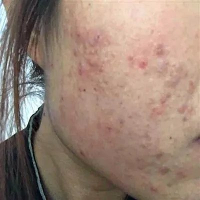 prp是什么意思