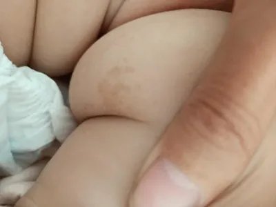 咖啡斑斑图片