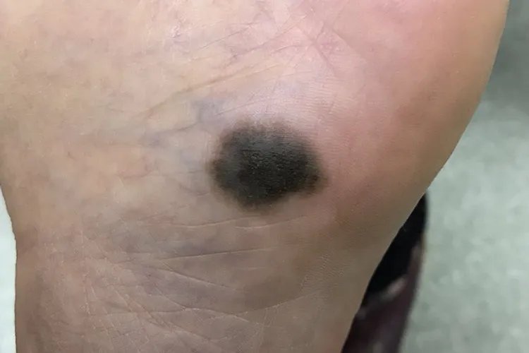 容易癌变的黑痣图片