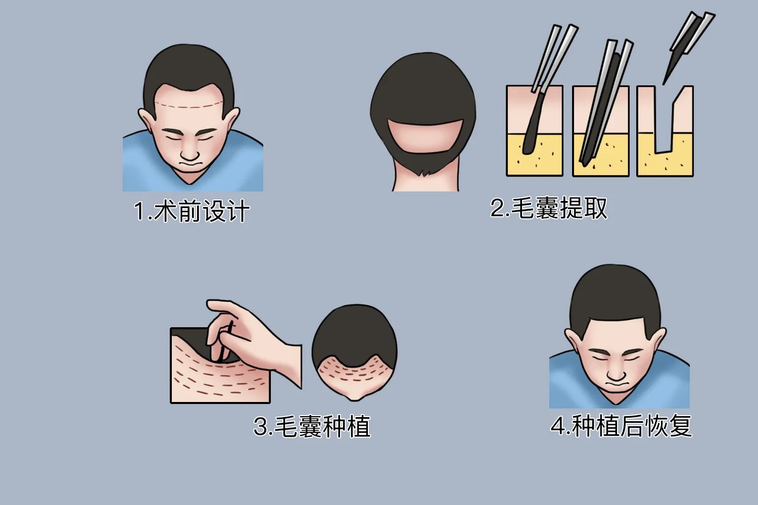 毛发种植术图片