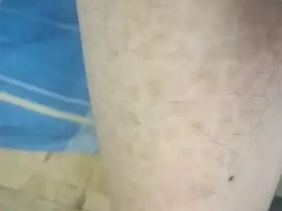 咖啡斑斑图片