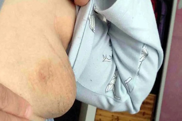 正常副乳图片
