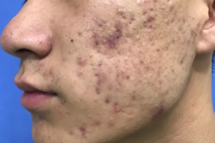 闭口痘痘长什么样子