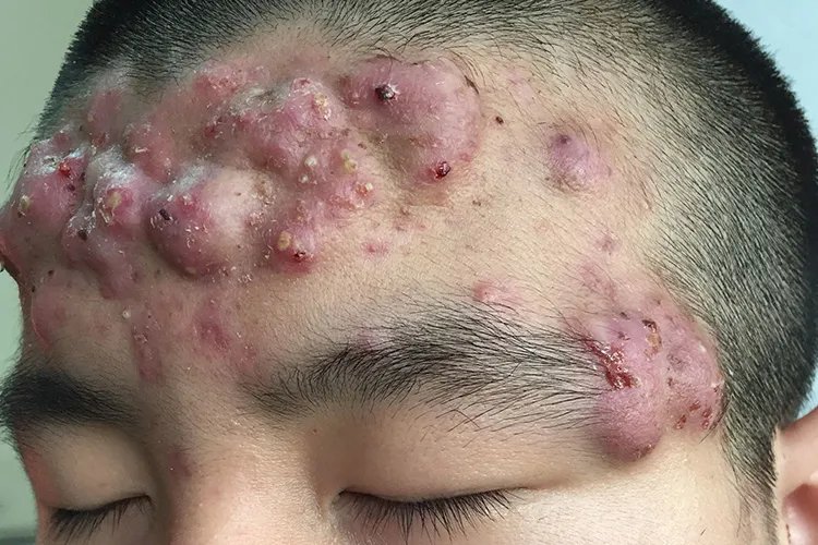 闭口痘痘长什么样子