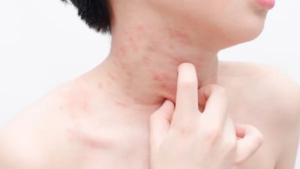 湿疹和热疹的区别图片 去除婴儿湿疹小妙招有哪些？