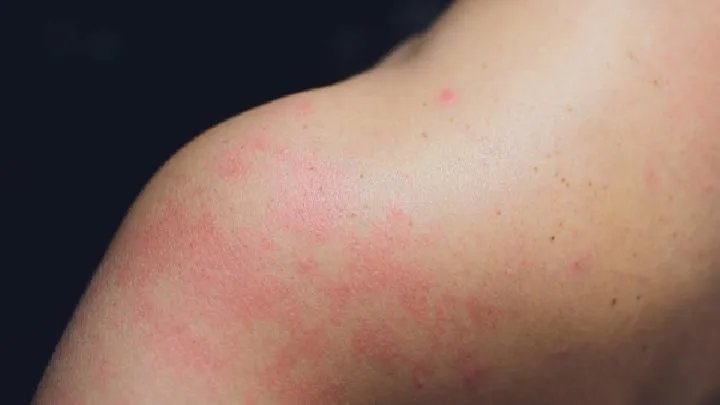 男科医生阐述过敏性皮炎几大危害