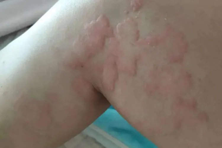 臭虫叮咬图片