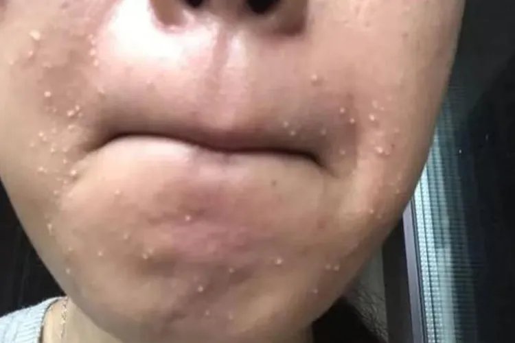 粉刺图片