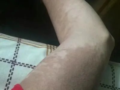 咖啡斑斑图片