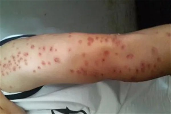 吸血臭虫怎么有效灭杀:人工捕捉(热水烫或太阳暴晒)