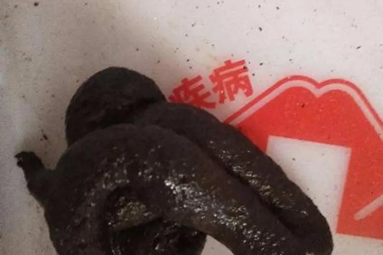 大便发黑图片