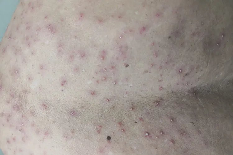 痱子症状图