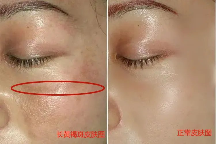 黄褐斑对比图