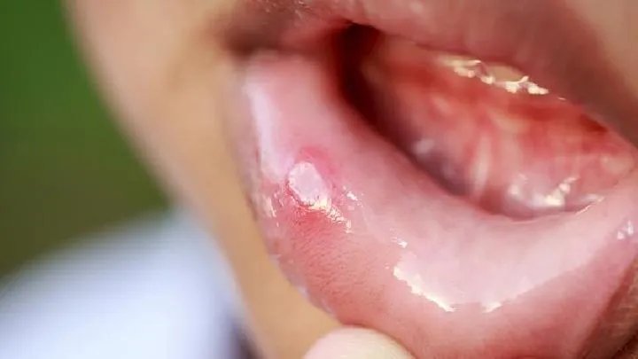唇裂是怎么引起的呢?