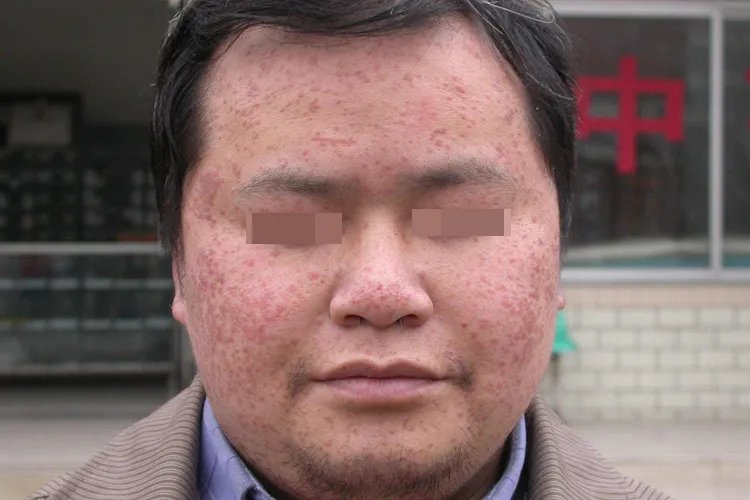 皮肤病扁平疣的图片