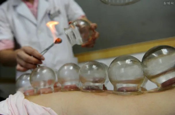 培训拔火罐致使女模特瞬间成火人 培训拔火罐注意事项