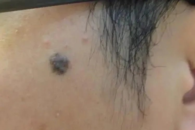 脸上黑色素瘤的图片