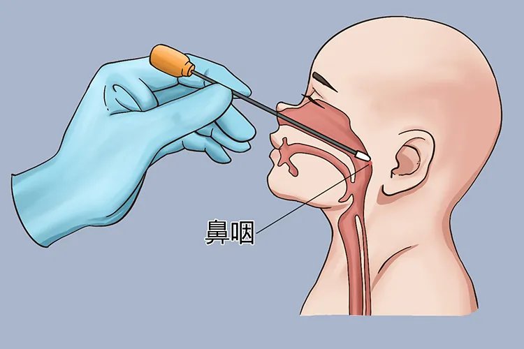 咽拭子所取部位图片