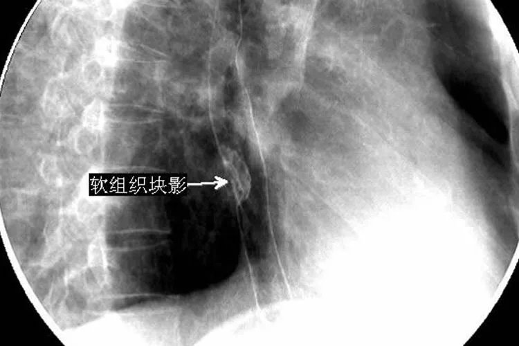 食道癌的早期症状表现