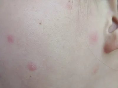 水痘红点图片