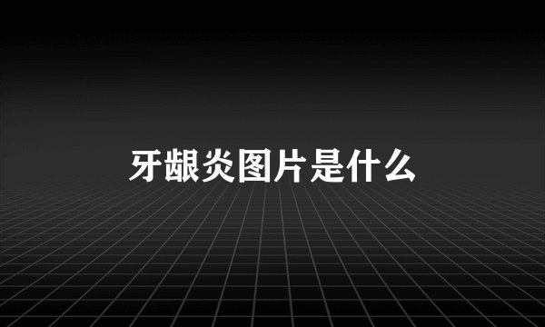 牙龈炎图片是什么