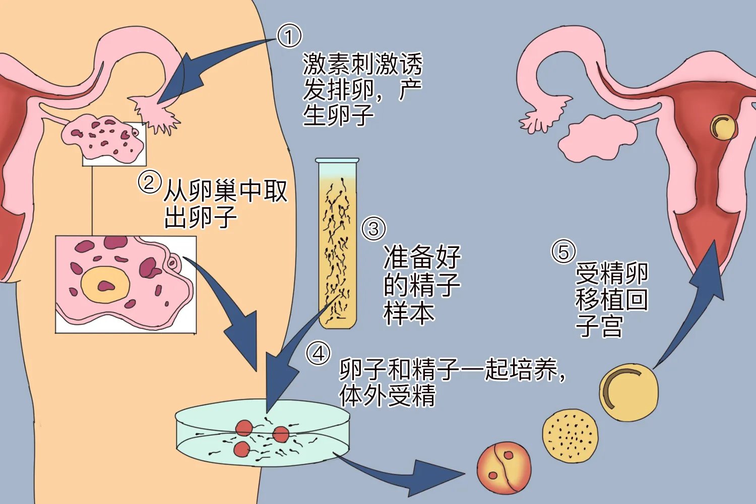 试管婴儿的流程是什么样的
