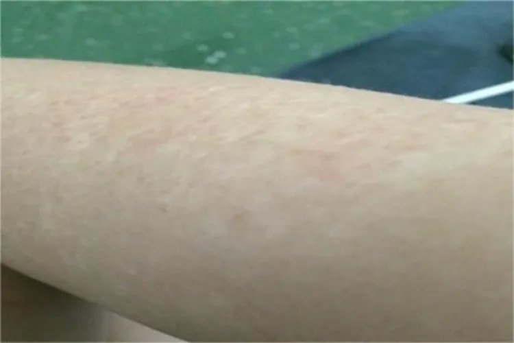 大腿汗斑癣图片大全