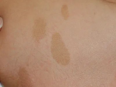 咖啡斑斑图片
