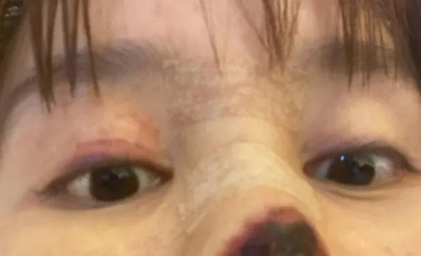 女星整容失败鼻头坏死,损失240万欲轻生,门诊是否需要承担责任?