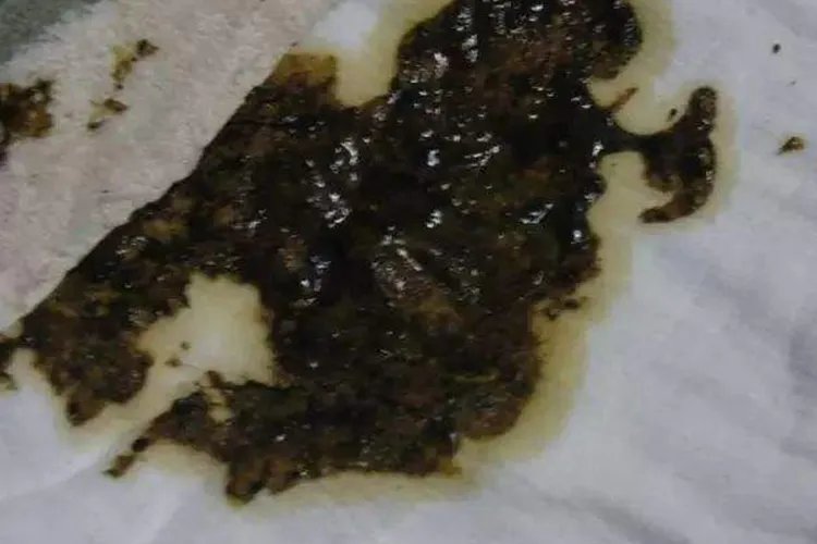 大便发黑图片