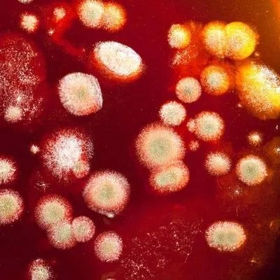 糠秕孢子菌毛囊炎怎么办